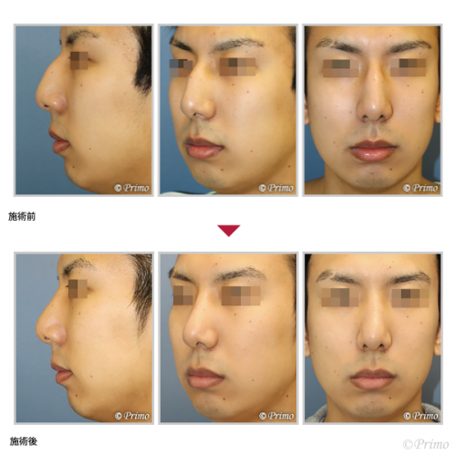 鷲鼻形成術 鼻の整形 プリモ麻布十番クリニック