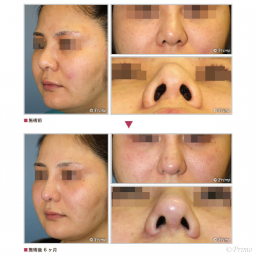 鼻翼縮小術 鼻の整形 プリモ麻布十番クリニック