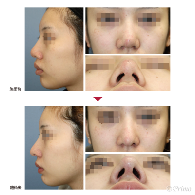 H 整鼻術＋鼻中隔延長術＋鼻背部軟骨移植術＋鼻翼縮小術（小鼻縮小術）内側法＋鼻孔縁挙上術 症例経過写真