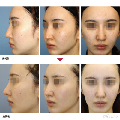 FG 鼻中隔延長術＋他院鼻プロテーゼ入れ替え術＋眉間プロテーゼ 症例経過写真