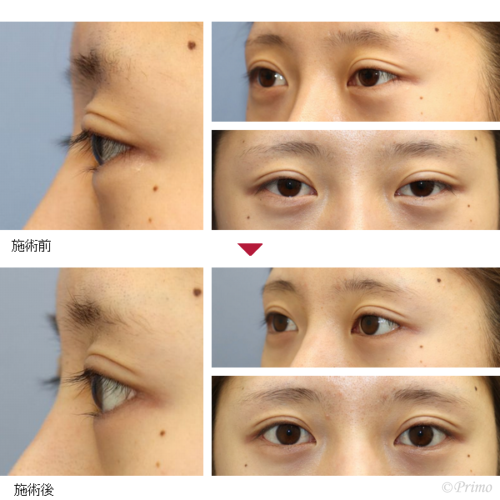 下眼瞼拡大術 たれ目形成 プリモ麻布十番クリニック