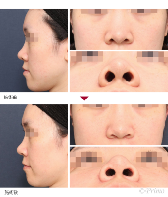 E 鼻翼縮小術（内側法＋外側法）＋鼻孔縁形成術 症例経過写真